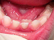 Baby Teeth - Pediatric Dentist in West Des Moines, IA