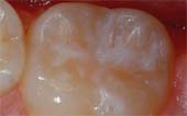 Sealant-After - Pediatric Dentist in West Des Moines, IA
